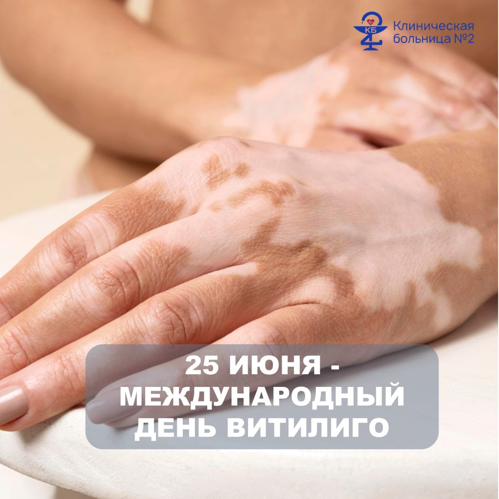 Витилиго